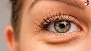 Göz Altı Torbalanmalarına Dikkat !